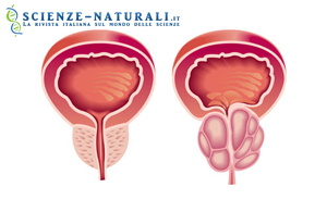 Raffigurazione di prostata in condizione fisiologiche (sinistra) ed affetta da ipertrofia prostatica (destra).