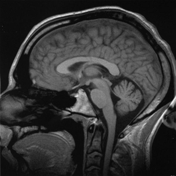 Esito di risonanza magnetica al cervello. La neocorteccia, sede delle funzioni cognitive, è la parte più esterna. (Fonte: Wikicommons)