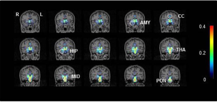 Neuro infiammazione nei pazienti con sindrome da stanchezza cronica / encefalite mialgica. Immagini rappresentative PET (tomografia a emissione di positroni) in varie aree del cervello: AMY: amigdala; CC: corteccia cingolata; HIP: ippocampo; MID: mesencefalo; THA: talamo; PON: ponte (credit: RIKEN)