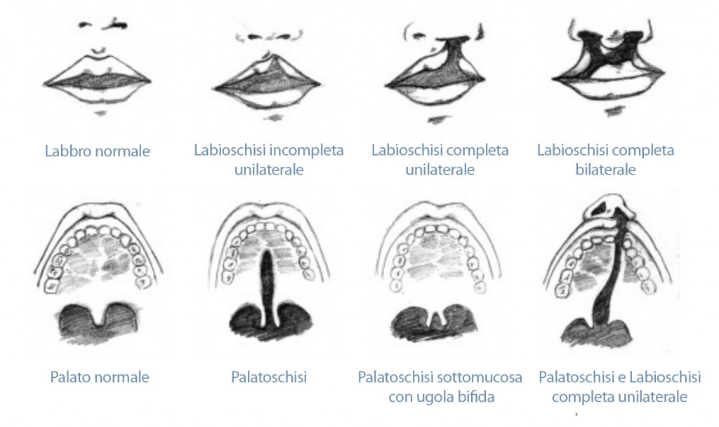 Confronto in condizioni fisiologiche e con presenza di labioschisi e palatoschisi secondo le varianti. (© Raymond Pahk, Stony Brook University).